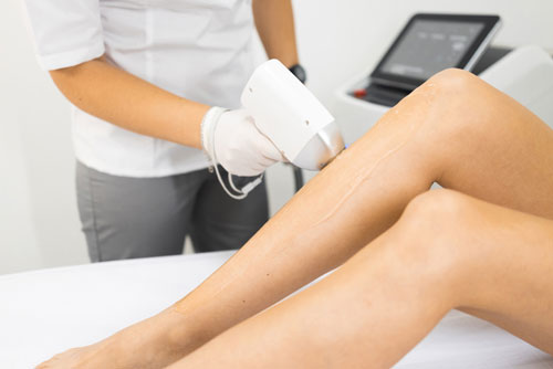 Laser Hair Removal