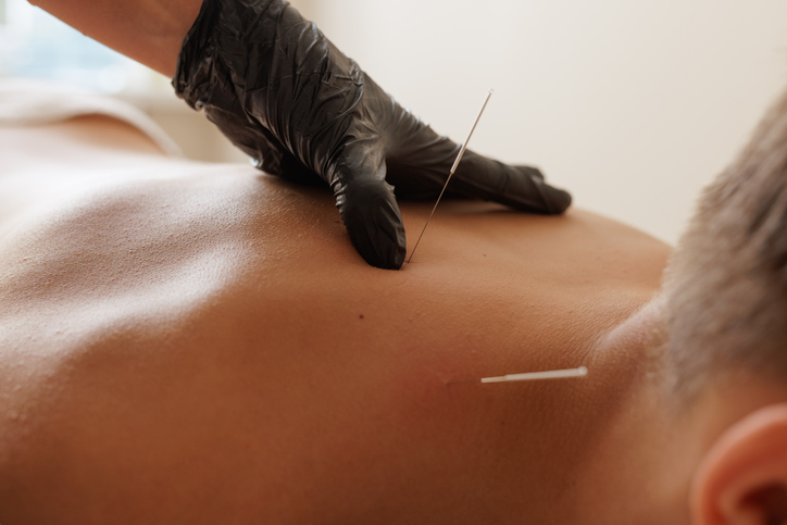 Close-up of dry needling session for muscle pain relief and rehabilitation, performed by a professional therapist